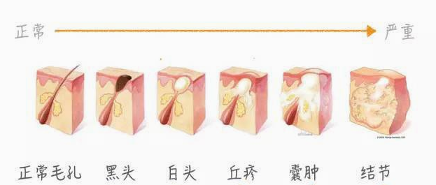 被称为“低调”的去黑头神器,却因价低被忽视!