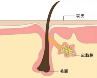 告别顽固黑头,你还差一个它