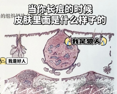 皮肤爆痘留印又留坑的真相